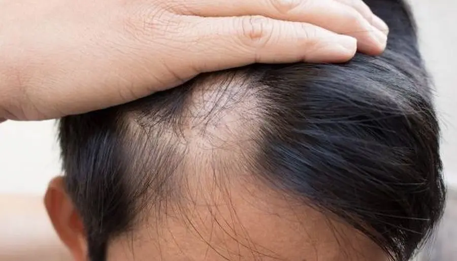 جلوگیری از ریزش مو هنگام کاهش وزن و تمرینات ورزشی